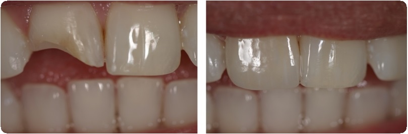 Восстановление переднего зуба3