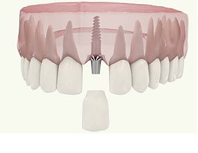 Протезирование одиночных зубов3
