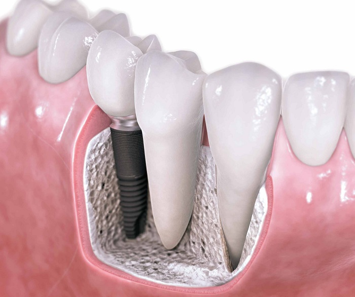 Осложнения при имплантации зубов верхней челюсти3