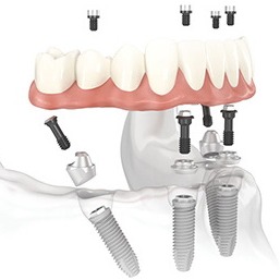 Установка несъемного зубного протеза3
