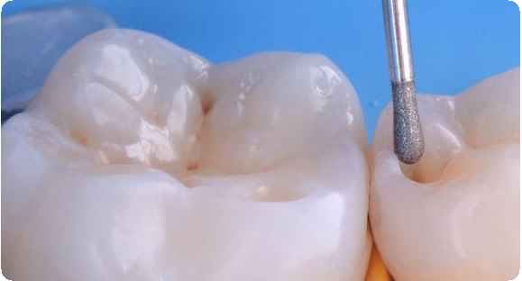 Протокол реставрации зубов3