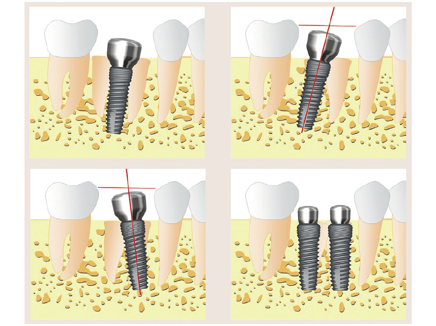 Установка имплантата сразу после удаления зуба3