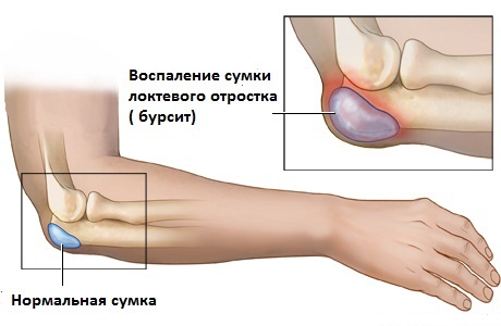 Почему болят локти рук: левый и правый3