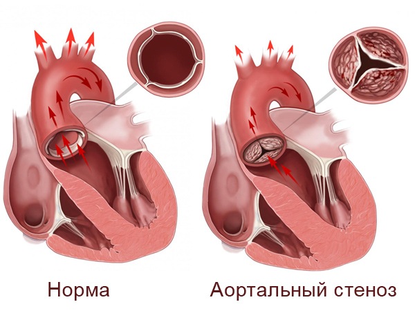 Изолированный клапанный стеноз легочной артерии3
