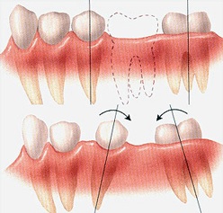 Осложнения после удаления зуба3
