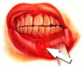 Кандидоз полости рта: симптомы, лечение3
