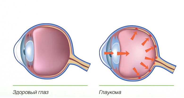 Глаукома: причины и проявления3