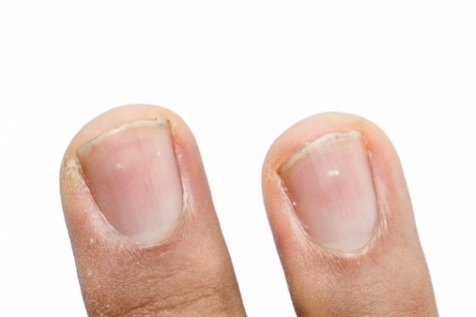 Белые пятна на ногтях рук, ног: причины3