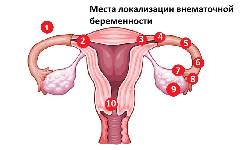 Признаки внематочной беременности3