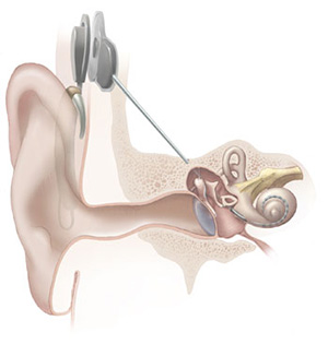 Неврит слухового нерва: причины, симптомы, лечение3