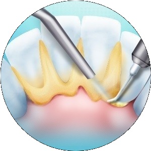 Зубной налет и зубной камень: как убрать3