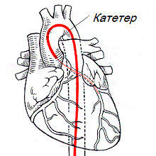 Диагностическая катетеризация сердца3