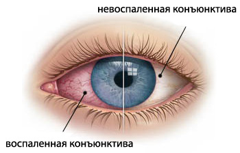 Почему болит глаз внутри: причины, последствия3