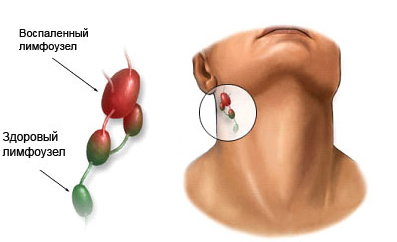 Почему болят лимфоузлы на шее: причины, последствия3
