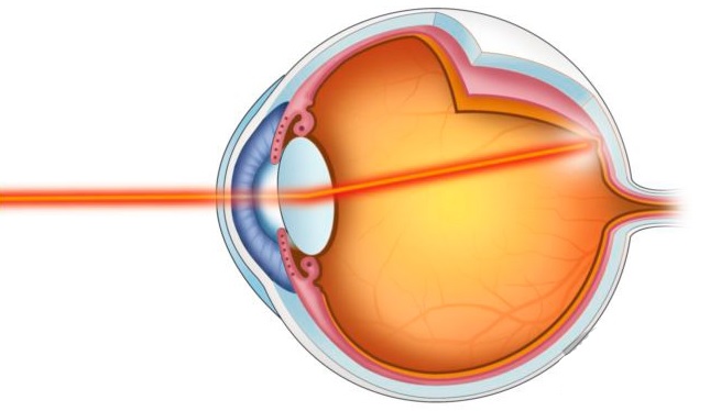 Ожог глаз кварцевой лампой: симптомы, лечение3