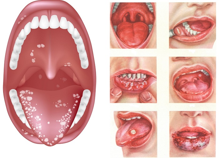 Как лечить язвы во рту?3