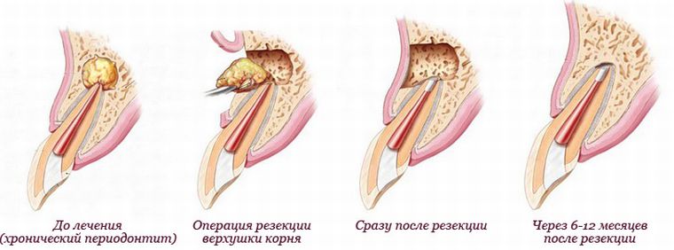 Почему болит корень зуба: причины, варианты лечения, последствия3