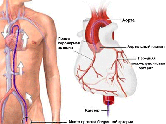 Аномалии отхождения коронарных артерий3