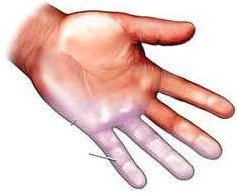 Почему болит кисть левой или правой руки: причины, последствия3