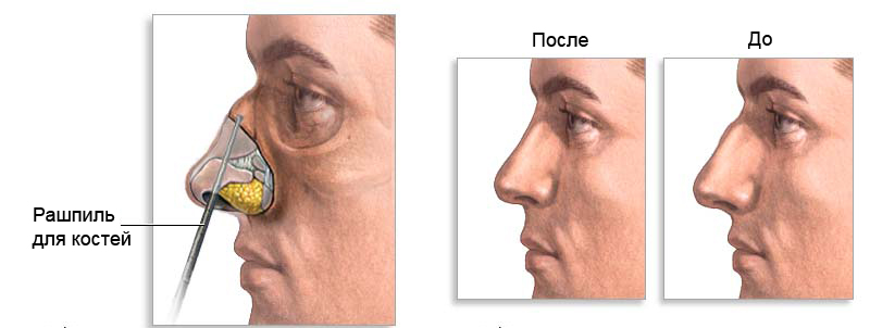 Хирургия носа3