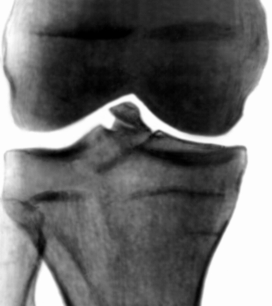 Перелом костей коленного сустава4