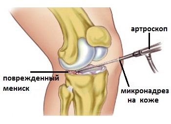 Повреждение мениска коленного сустава4