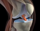 Перелом костей коленного сустава