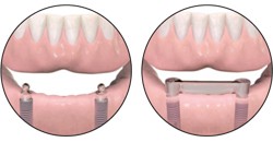 Перекрывающие зубные протезы4