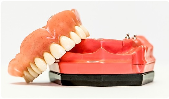 Имплантация верхней челюсти при частичном отсутствии зубов4