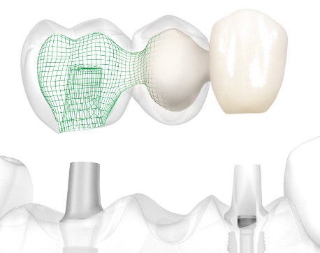 Выбор материала для зубного имплантата4