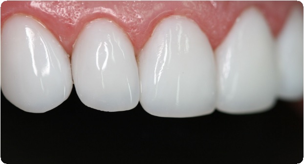 Особенности восстановления передних зубов4