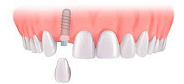 Имплантация одиночных зубов4