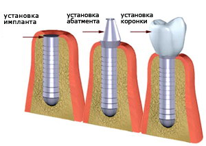 Особенности дизайна зубного имплантата4