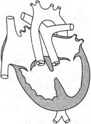 Изолированный клапанный стеноз легочной артерии4