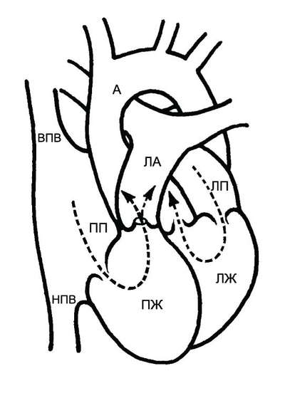 Периферический стеноз легочной артерии4