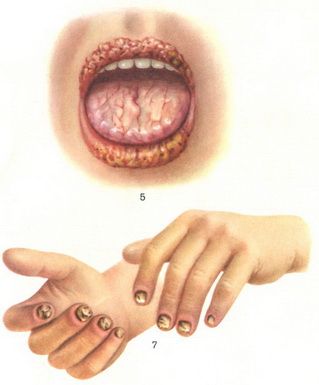 Кандидоз полости рта: симптомы, лечение4