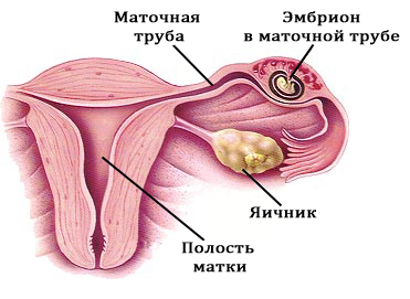 Признаки внематочной беременности4