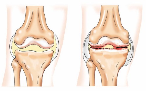 Причины боли в коленном суставе4