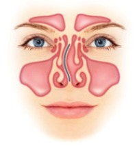 Искривление носовой перегородки: лечение, операция4