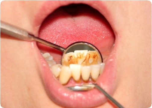 Зубной налет и зубной камень: как убрать4