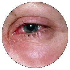 Ожог глаз: сваркой, химический ожог. Первая помощь при ожоге глаза4