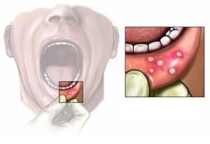 Как лечить язвы во рту?5