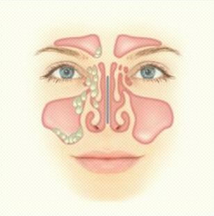 Почему болит переносица носа: причины, последствия4