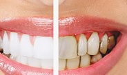 Зубной налет и зубной камень