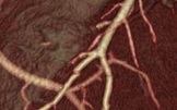 Фистула коронарной артерии