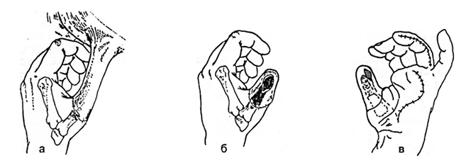 Первый палец кисти5