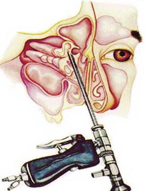 Эндоскопическая операция на пазухах носа5