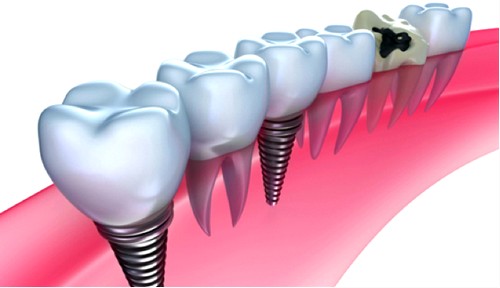 Имплантаты, соединенные с зубами5
