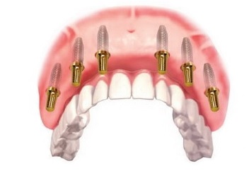 Имплантация верхней челюсти при частичном отсутствии зубов5