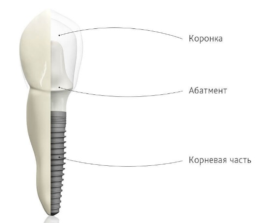 Выбор материала для зубного имплантата5